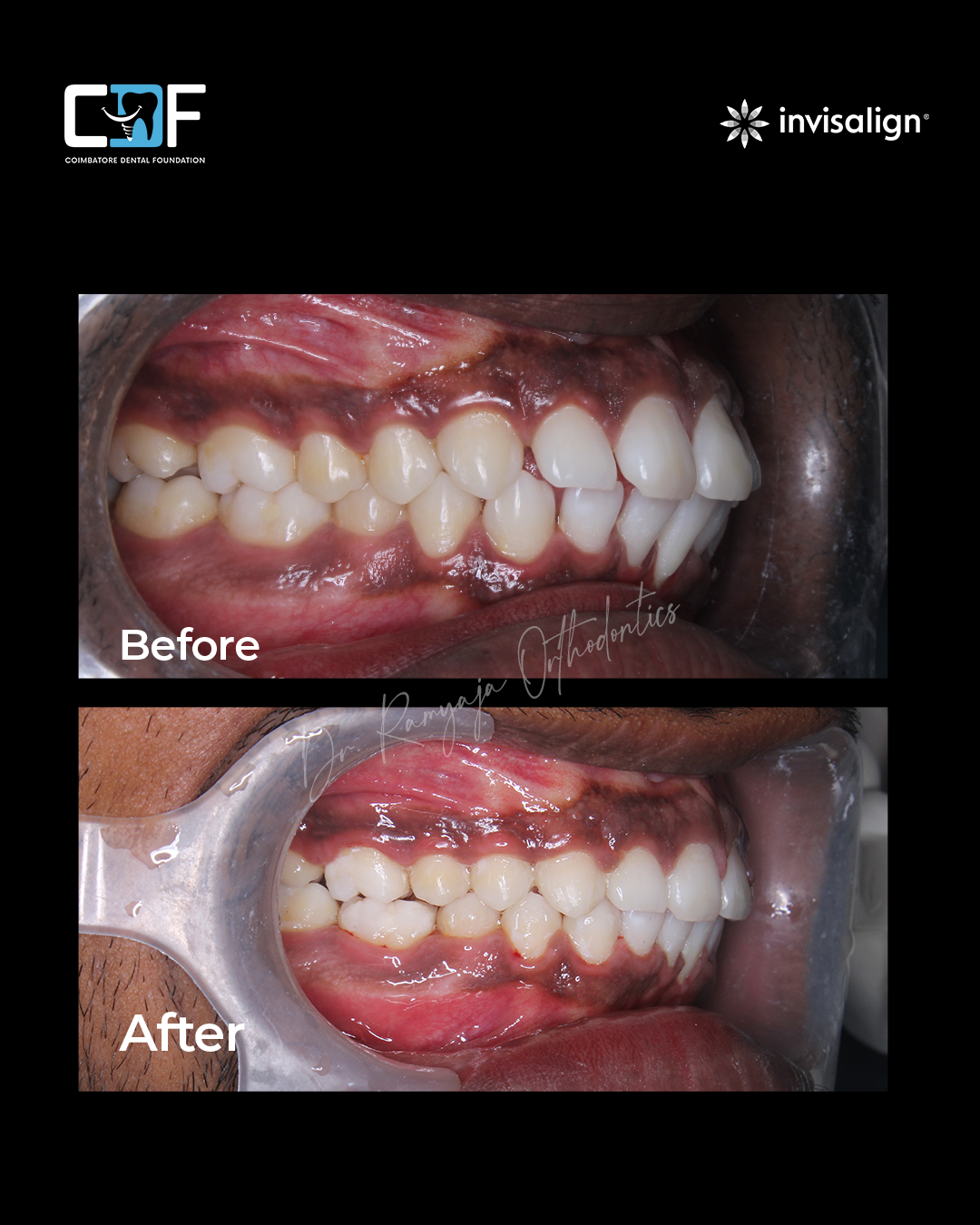 Before After Result